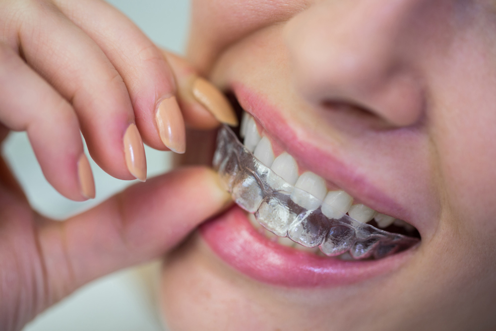 aparelho dentista comum invisivel